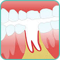 Хирургическое лечение альвеолита зуба
