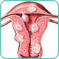 Миома: симптомы и лечение