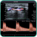 Дуплексное и триплексное сканирование экстракраниальных артерий
