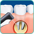 Закрытие перфорации зуба (Pro Root MTA)